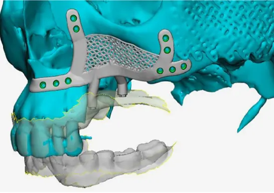 implante subperióstico de titanio en una reconstrucción maxilar