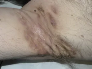 hidradenitis supurativa