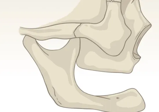 Atrofia severa de hueso maxilar y mandibular