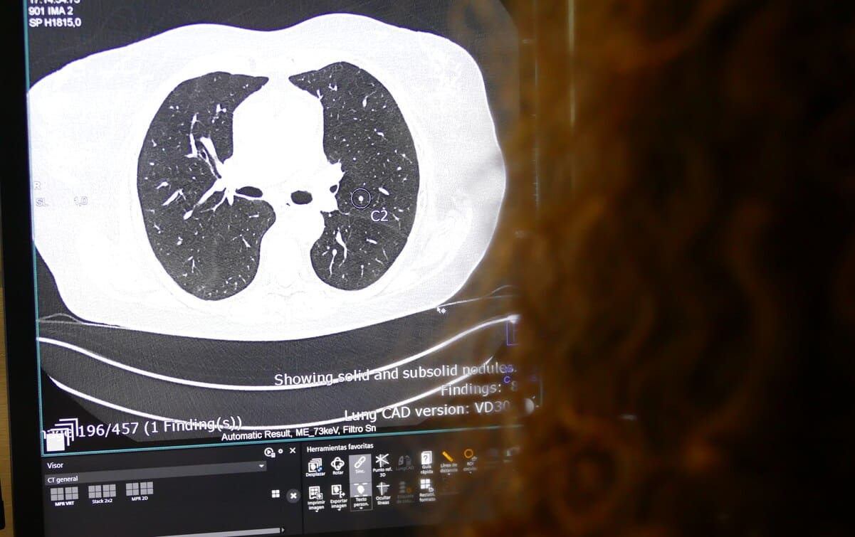 IA en Diagnóstico por la Imagen4_nodulo pulmonar