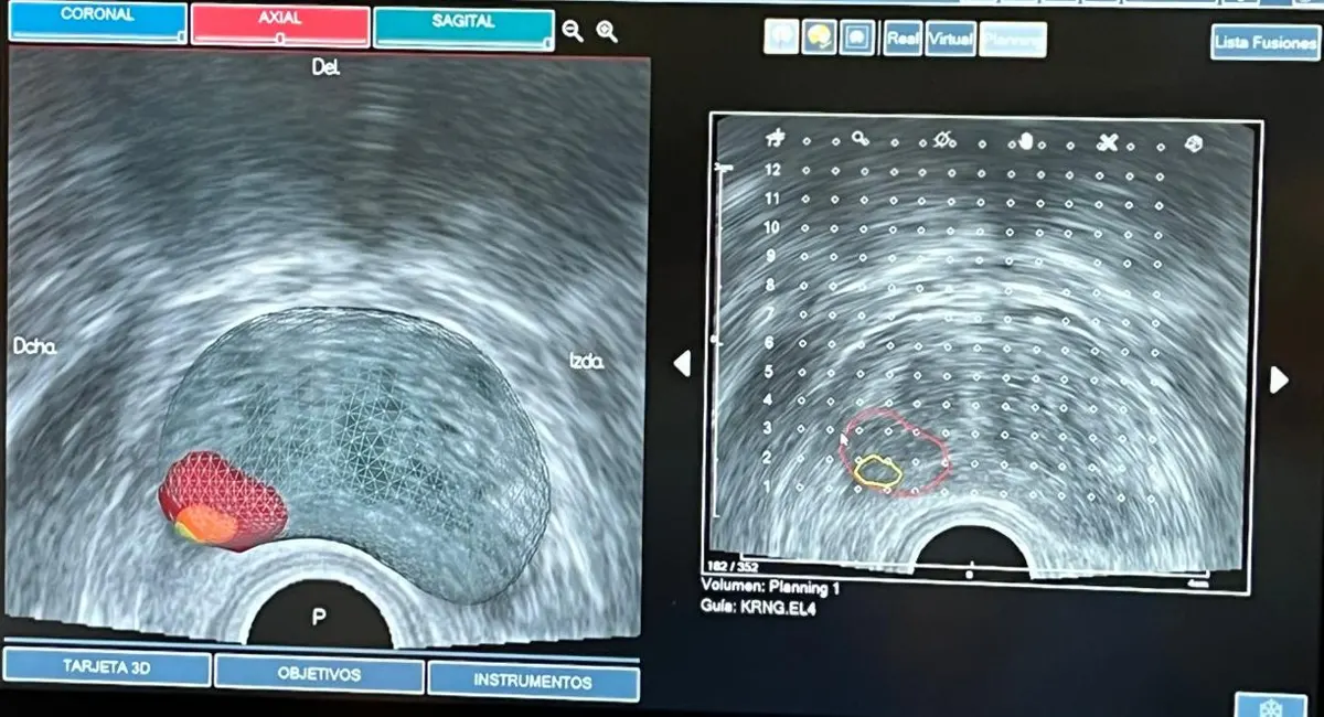 Imagen fusionada de resonancia magnética y ecografía para el tratamiento focal del cáncer de próstata.