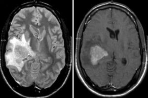 Linfoma cerebral