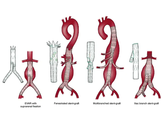 tratamientos para patologías de la aorta