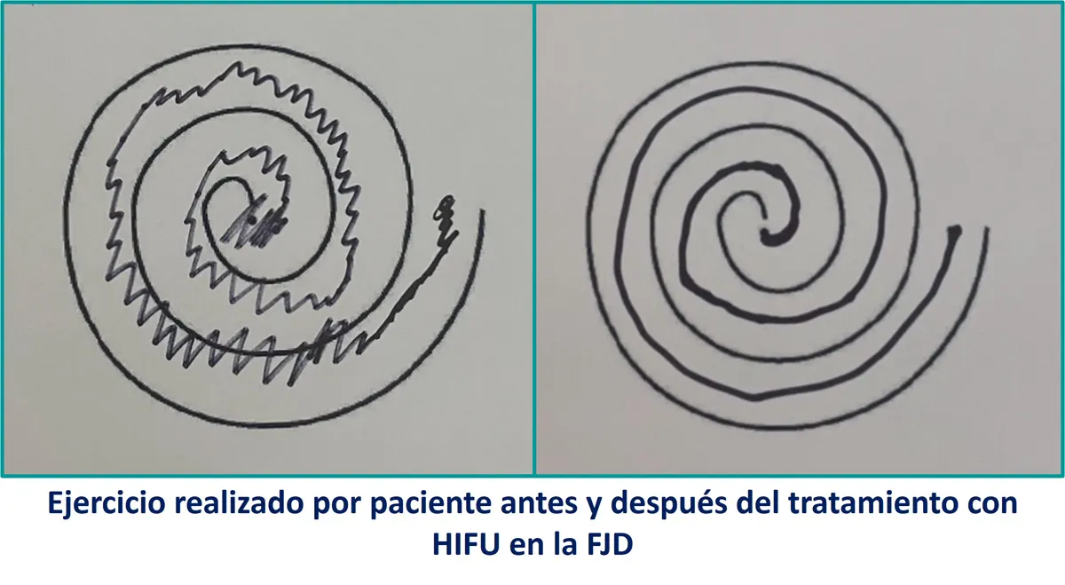 Ejercicio realizado por paciente antes y después del tratamiento con HIFU en la FJD